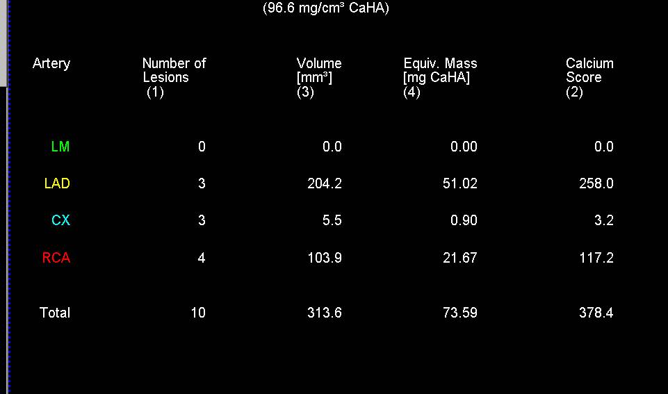 CCTA: Coronary Artery Calcification with Elevated Calcium Score without Critical Stenosis - CTisus CT Scan