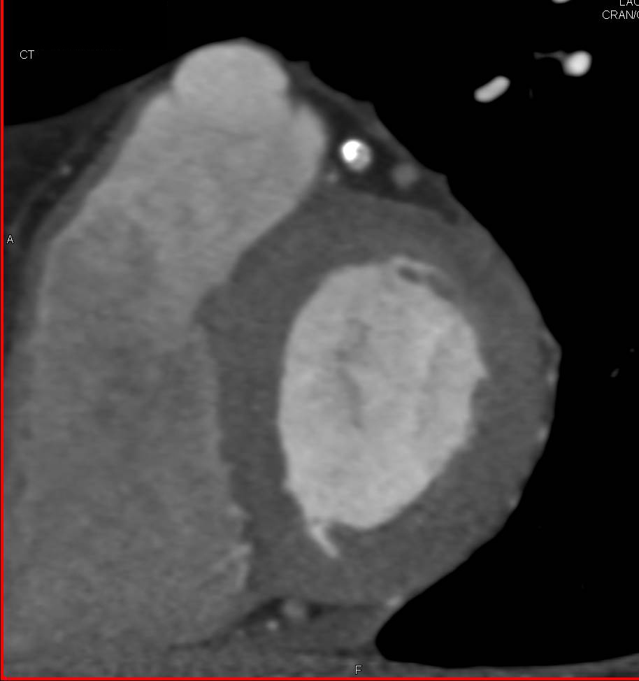 CCTA: Coronary Disease with Mixed Plaque in the Left Anterior Descending Coronary Artery (LAD) - CTisus CT Scan