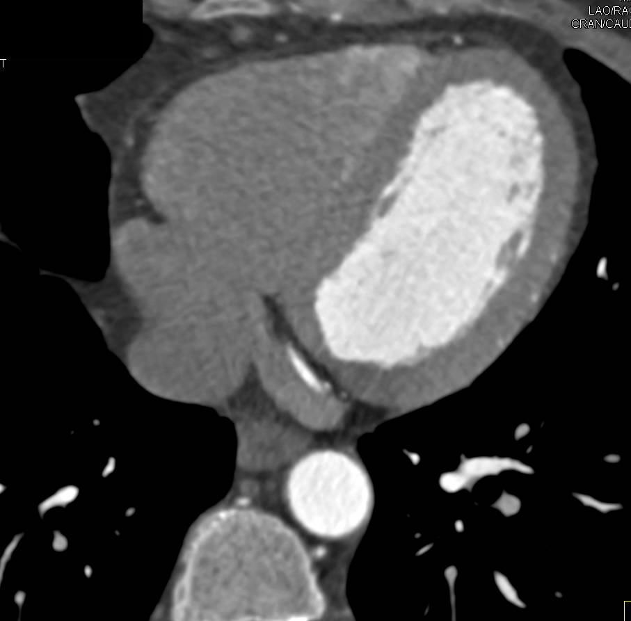 CCTA: Normal Coronary Artery Anatomy - CTisus CT Scan