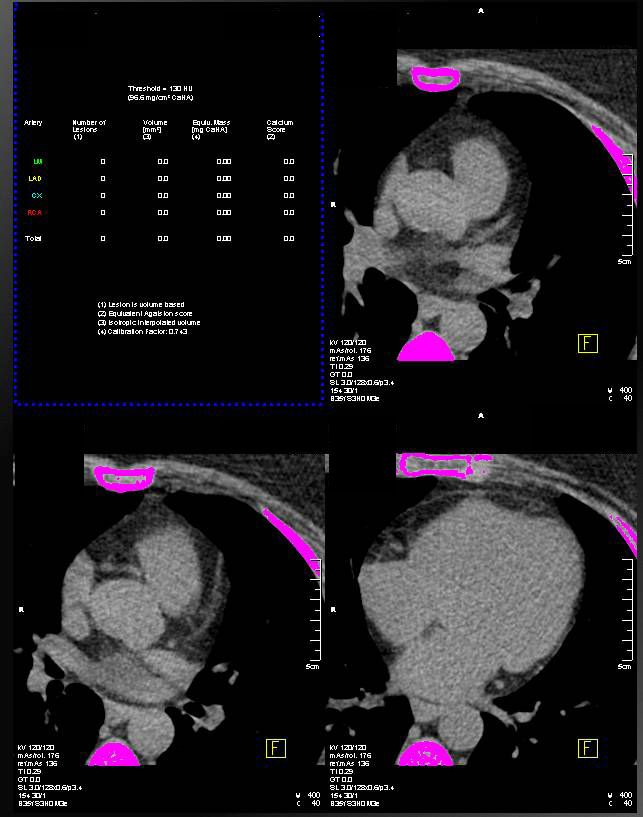 CCTA: Normal Coronary Artery Aneurysm - CTisus CT Scan