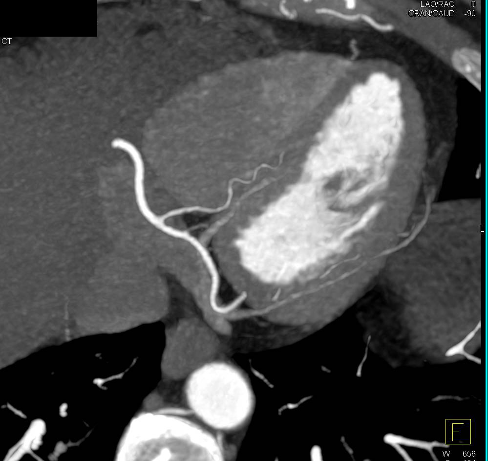 CCTA: Left Anterior Descending Coronary Artery (LAD) Plaque with Approximately 50% Stenosis - CTisus CT Scan