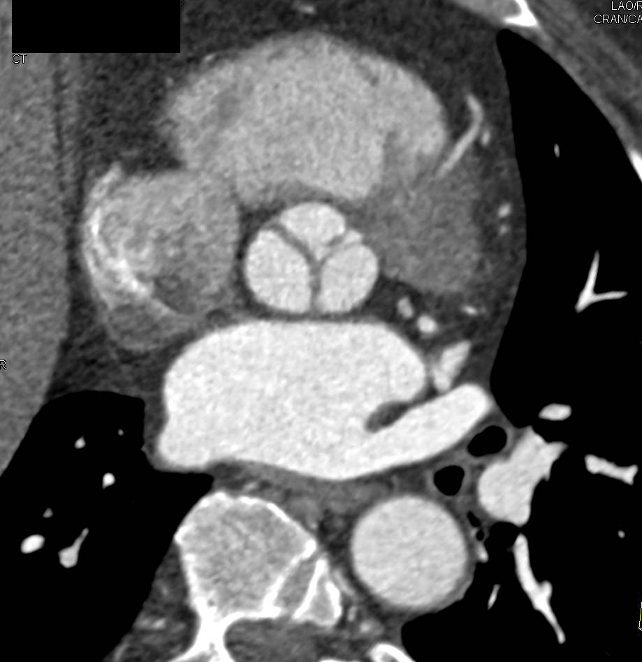 Normal Aortic Valve - CTisus CT Scan