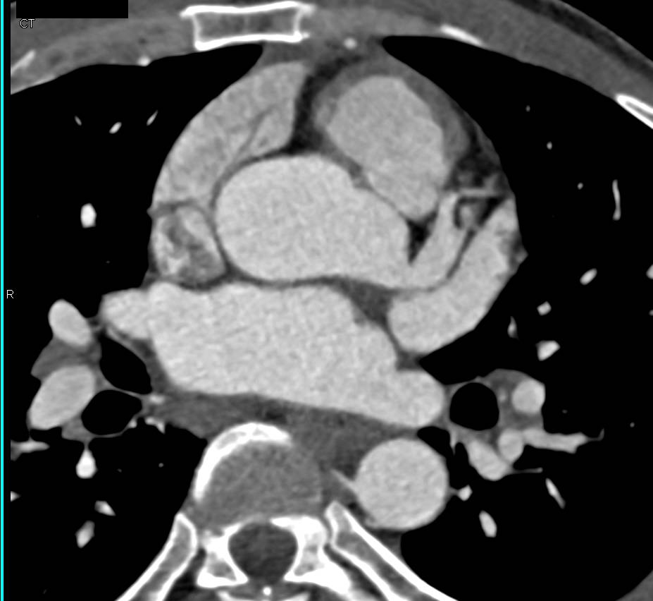 CCTA: Aneurysm of the Left Main Coronary Artery - CTisus CT Scan