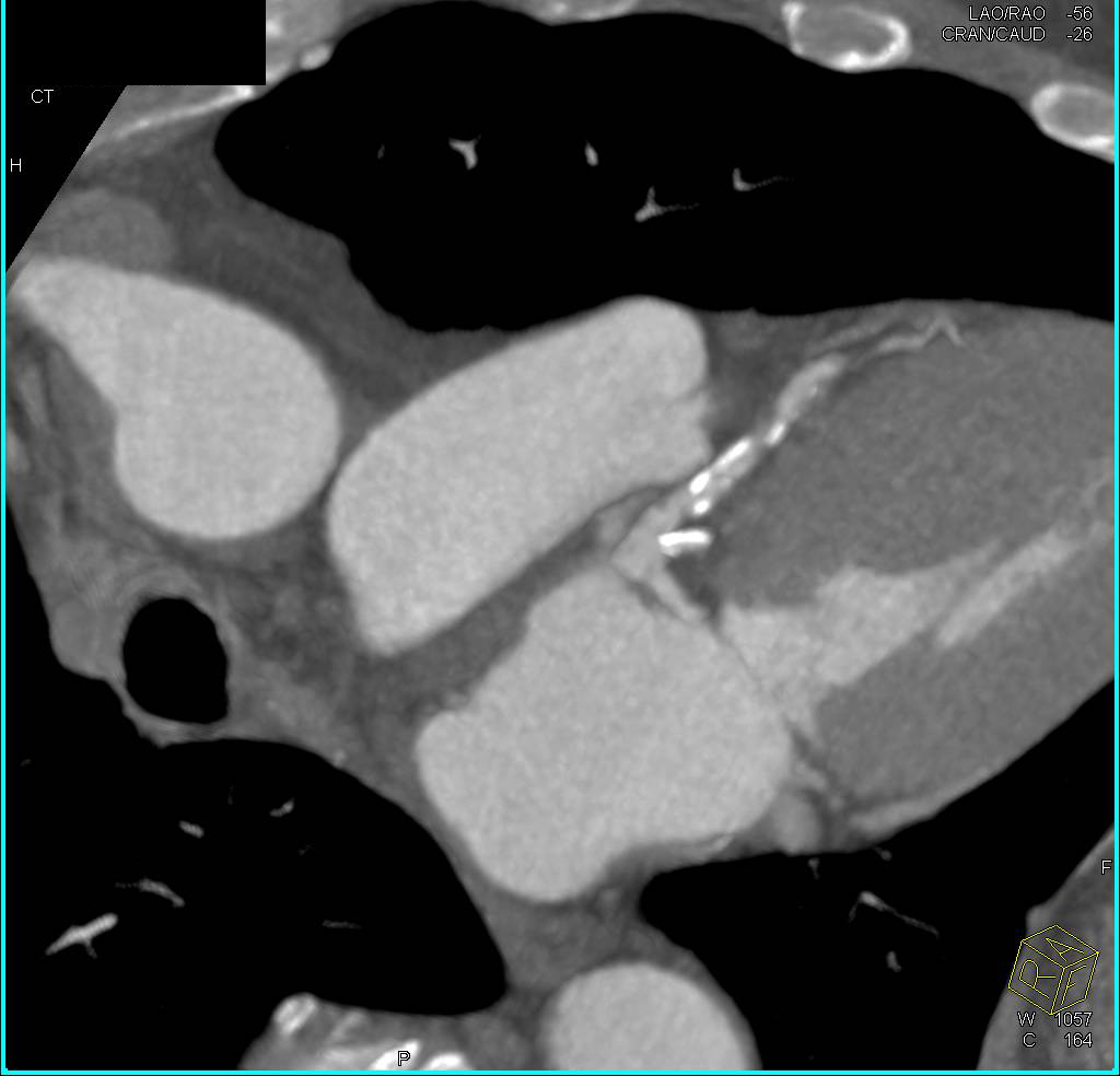 CCTA: Coronary CTA with Occluded Right Coronary Artery (RCA) and ...