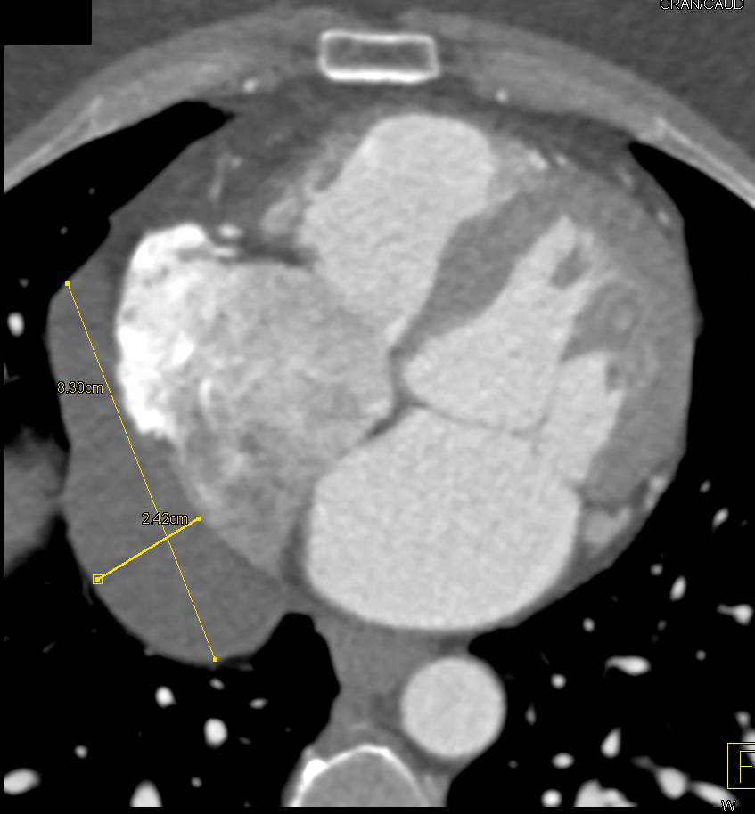 Pericardial Cyst in Multiple Perspectives - CTisus CT Scan