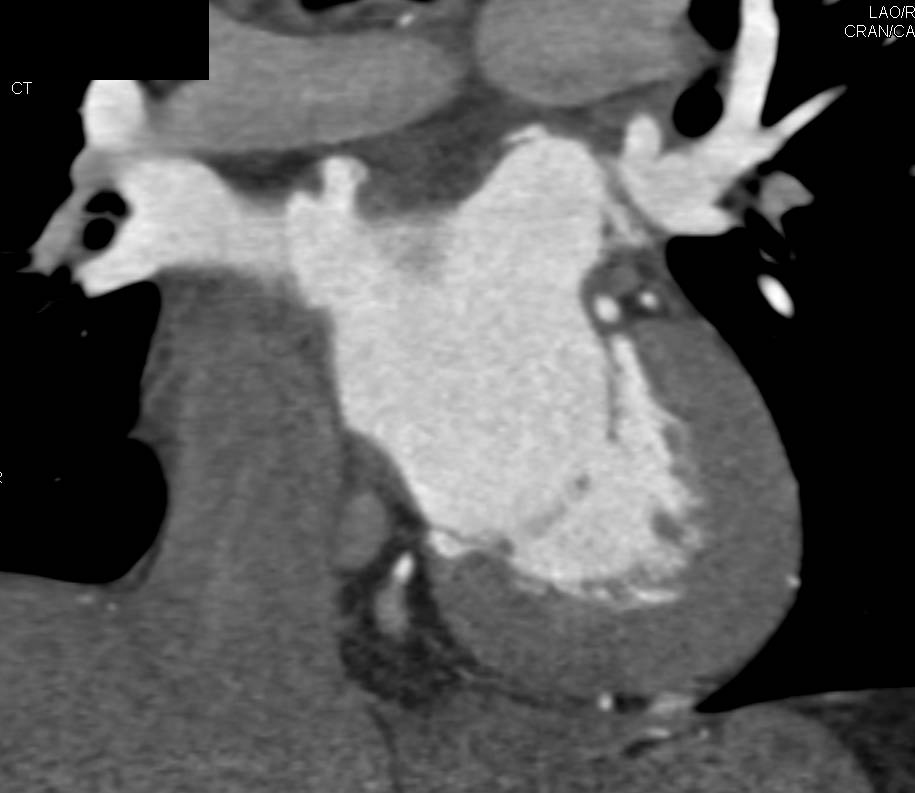 CTA: Normal Coronary Artery Anatomy and Diverticulum off Left Atrium - CTisus CT Scan