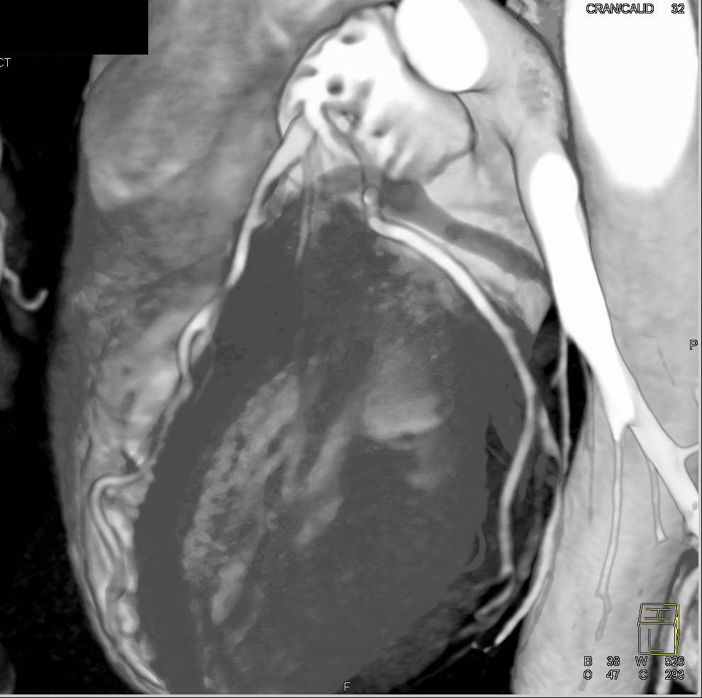 CCTA: Multivessel Disease with Approximately 50% Left Anterior Descending Coronary Artery (LAD) Stenosis in 3D - CTisus CT Scan