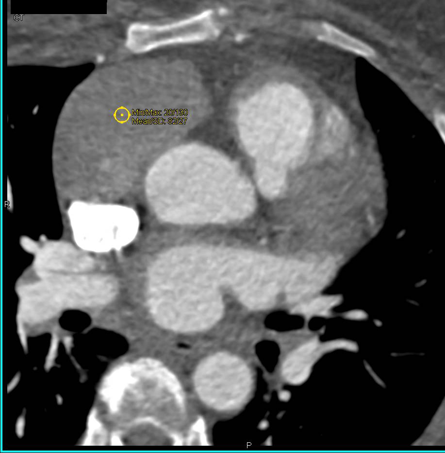 Pericardial Cyst in 3D - CTisus CT Scan