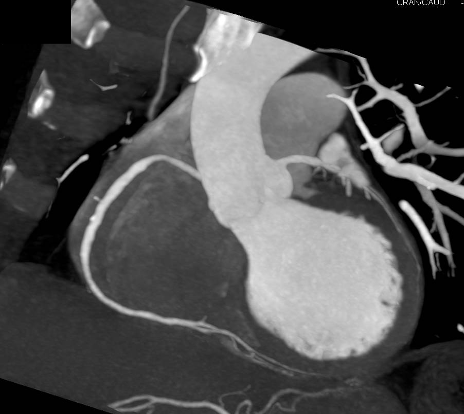 CCTA: Coronary CTA with Mixed Plaque Best Seen in Left Anterior Descending Coronary Artery (LAD) - CTisus CT Scan