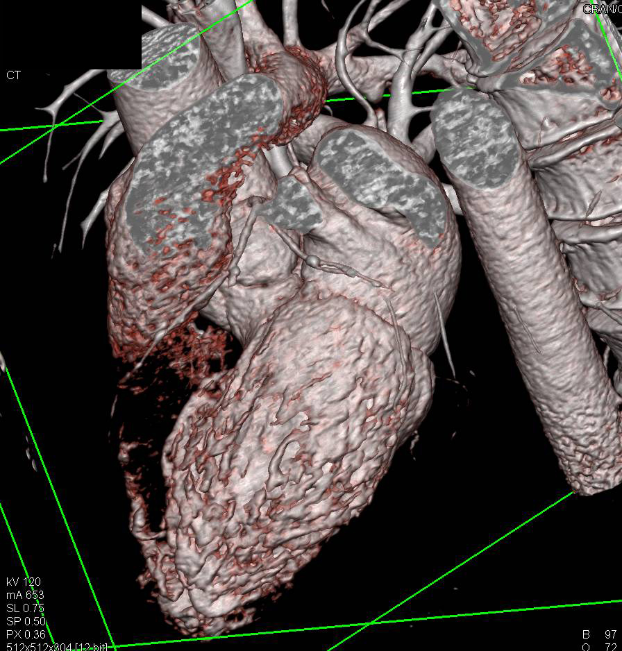 CCTA: Coronary CTA with Calcified Plaques but no Evidence of Critical Stenosis - CTisus CT Scan