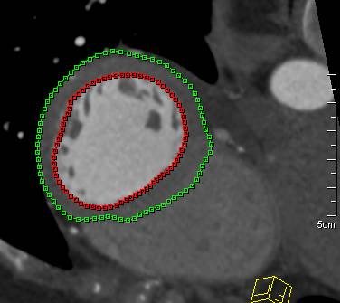 Volume of Left Ventricle in 3D Calculations - CTisus CT Scan