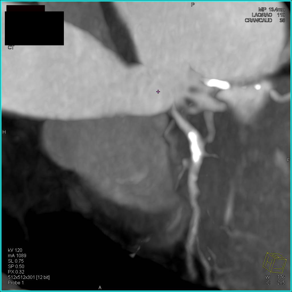 CCTA: Coronary Artery Disease - CTisus CT Scan