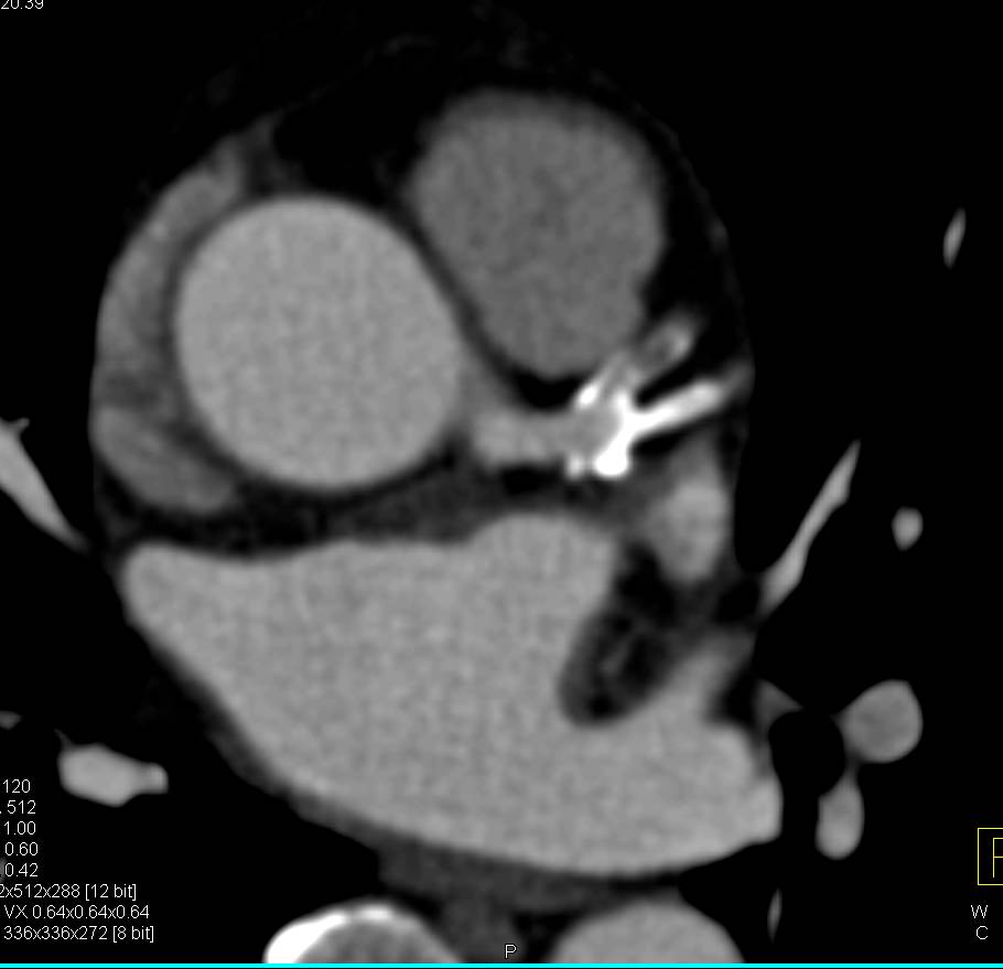 CCTA: Multivessel Disease with High Grade Stenosis in Left Anterior Descending Coronary Artery (LAD) - CTisus CT Scan