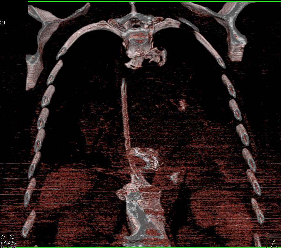 Retained Sponge in the Posterior Mediastinum - CTisus CT Scan