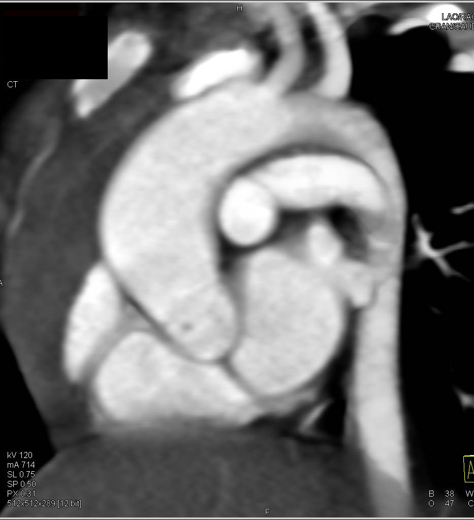 Dilated Ascending Aorta with a Bicuspid Valve - CTisus CT Scan