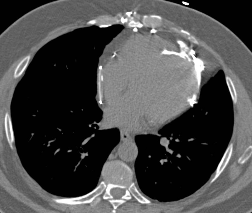 Extensive Pericardial Calcification - CTisus CT Scan