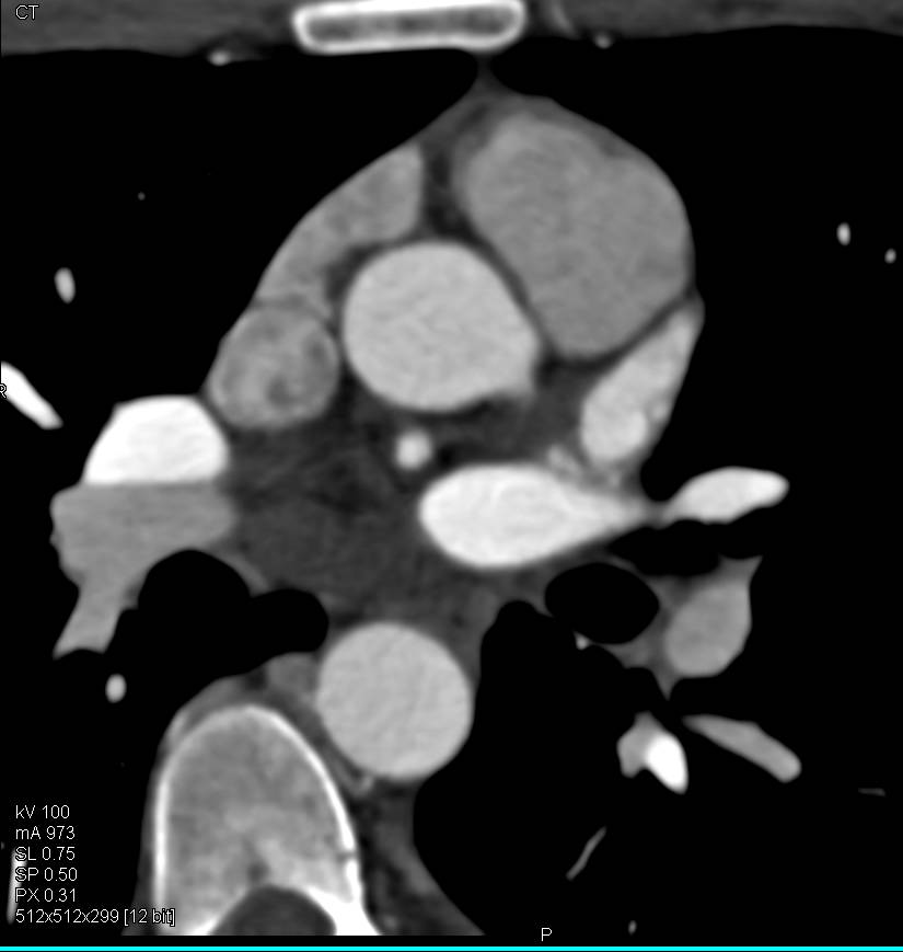 CCTA with Normal Left Atrial Appendage - CTisus CT Scan