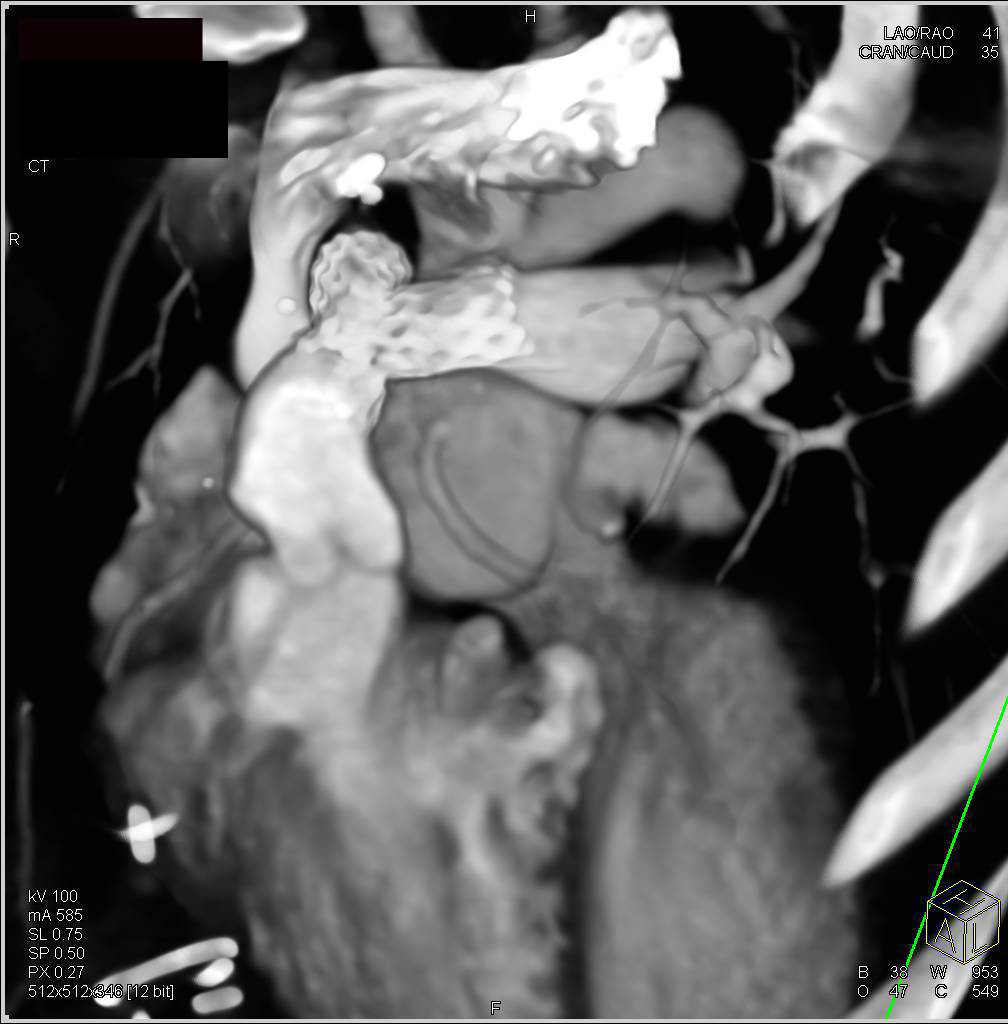 Tetralogy of Fallot with Patent Stents in the Pulmonary Arteries - CTisus CT Scan