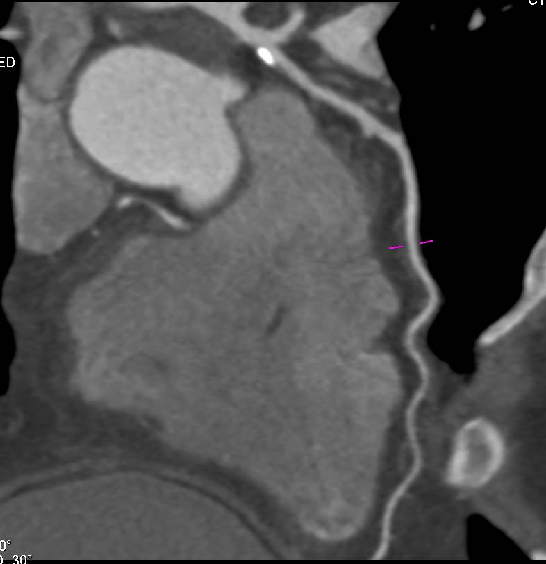 CCTA: Calcified Plaque in Left Anterior Descending Coronary Artery (LAD) - CTisus CT Scan