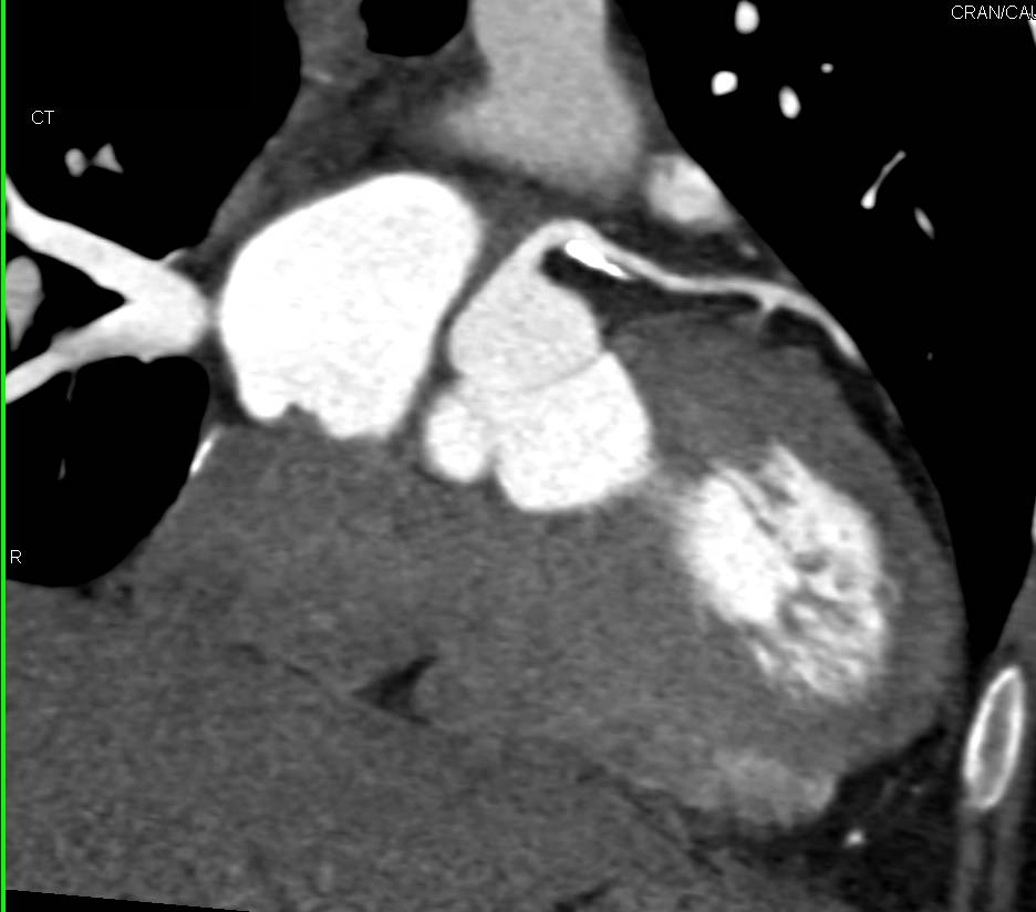 CCTA: Calcified Plaque in Left Main Coronary Artery and Left Anterior Descending Coronary Artery (LAD) - CTisus CT Scan