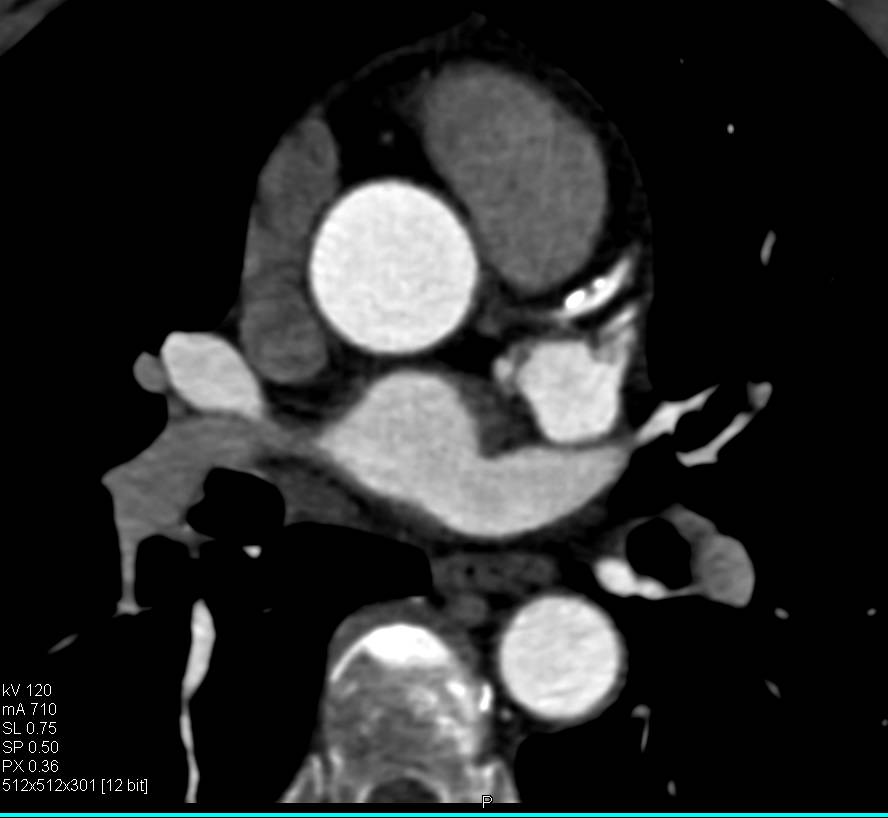 CCTA: Mixed Plaque in Left Anterior Descending Coronary Artery (LAD) with Stenosis Under 50% - CTisus CT Scan