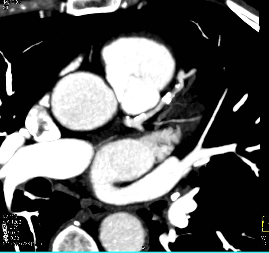 CCTA: Critical Left Anterior Descending Coronary Artery (LAD) Stenosis - CTisus CT Scan