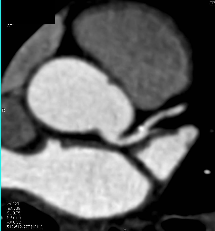 CCTA: Left Anterior Descending Artery (LAD) Plaque without Stenosis - CTisus CT Scan