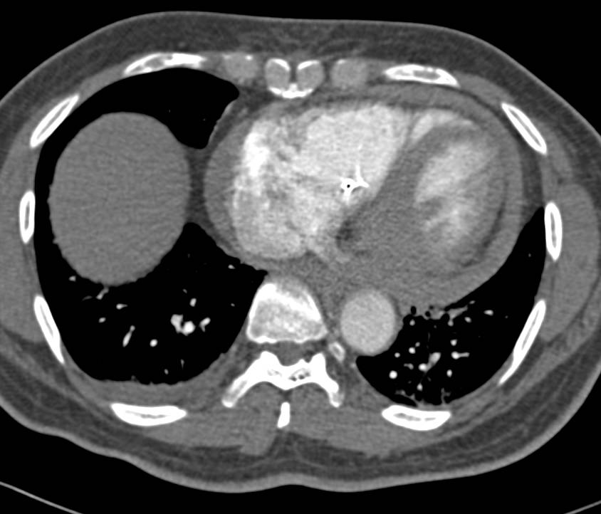 Acute Pericarditis - CTisus CT Scan