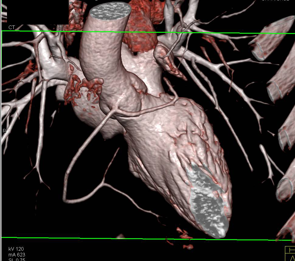 CCTA: Left Main Coronary Artery arises off the Right Coronary Artery Trunk - CTisus CT Scan