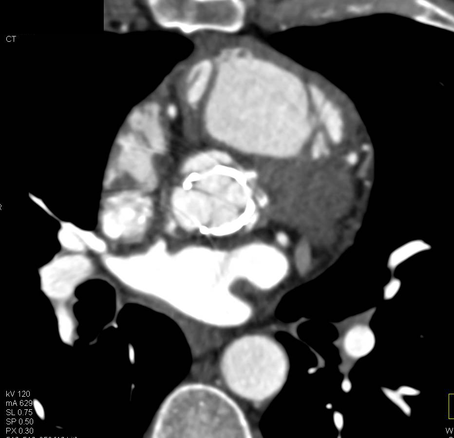 3D Mapping of Aortic Valve Replacement - CTisus CT Scan