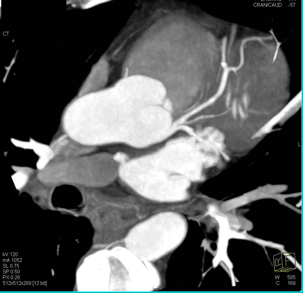 CCTA: Left Anterior Descending Coronary Artery (LAD) Plaque without Critical Stenosis - CTisus CT Scan