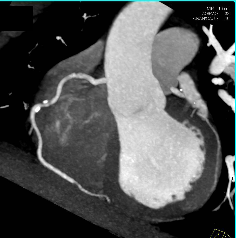 CCTA: Multivessel Disease with Most Mixed Plaque and Around 50% Stenosis in Left Anterior Descending Coronary Artery (LAD) - CTisus CT Scan