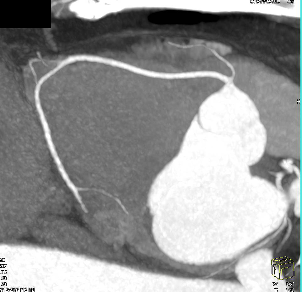 CCTA: Normal Right Coronary Artery (RCA) - CTisus CT Scan