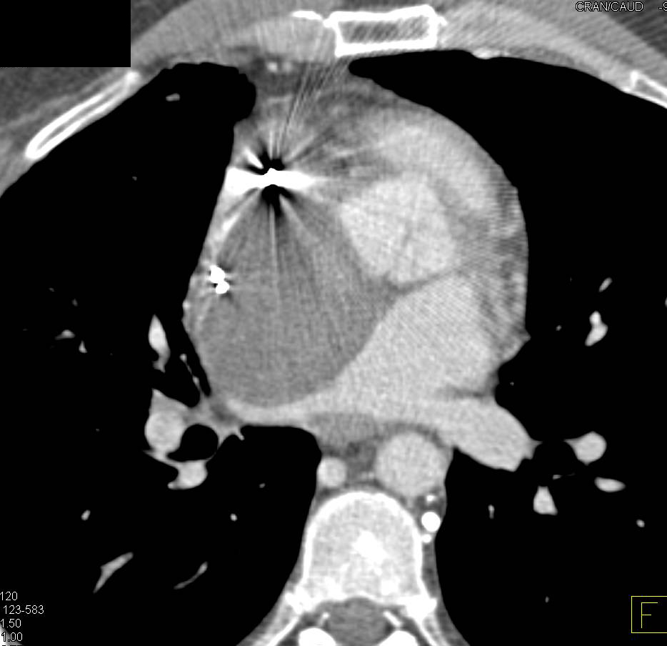 Angiosarcoma - CTisus CT Scan