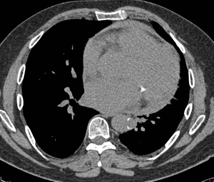 Pericardial Hemorrhage - CTisus CT Scan