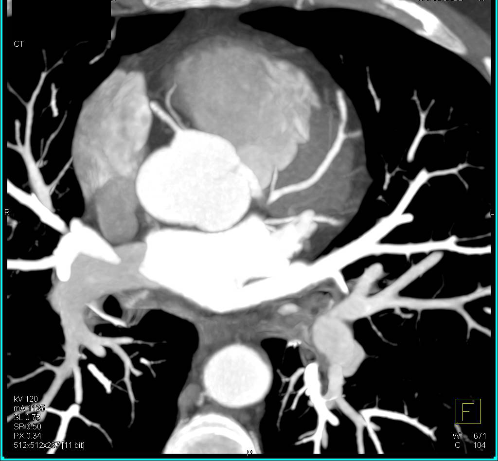 CCTA: Conus Branch Arises off the Right Cusp - CTisus CT Scan