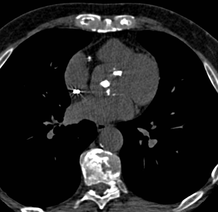 Extensive Aortic Valve Calcification - CTisus CT Scan