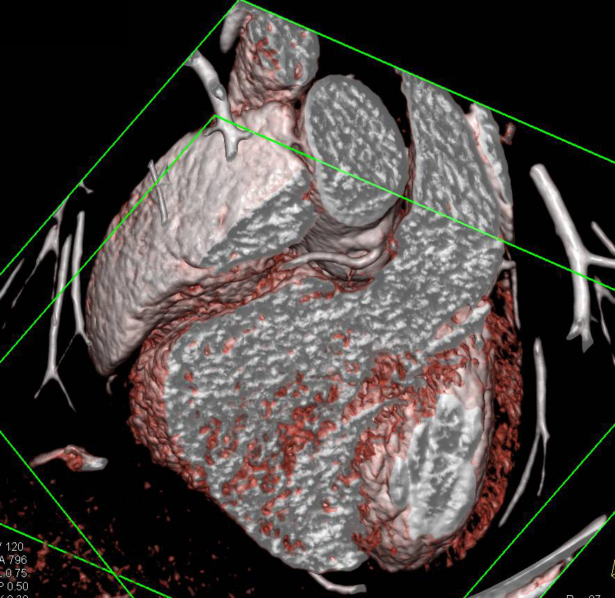 CCTA: Normal 3D Mapping - CTisus CT Scan