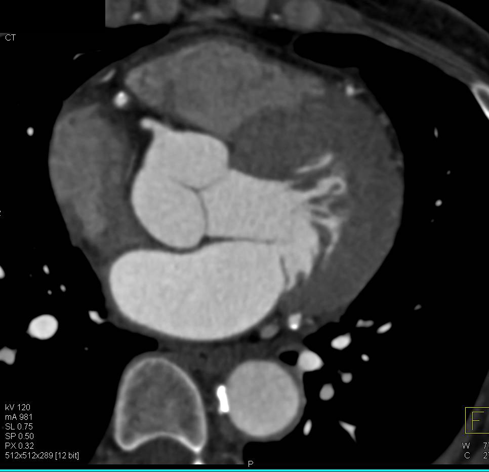 CCTA: Multivessel Disease with Extensive Plaque - CTisus CT Scan