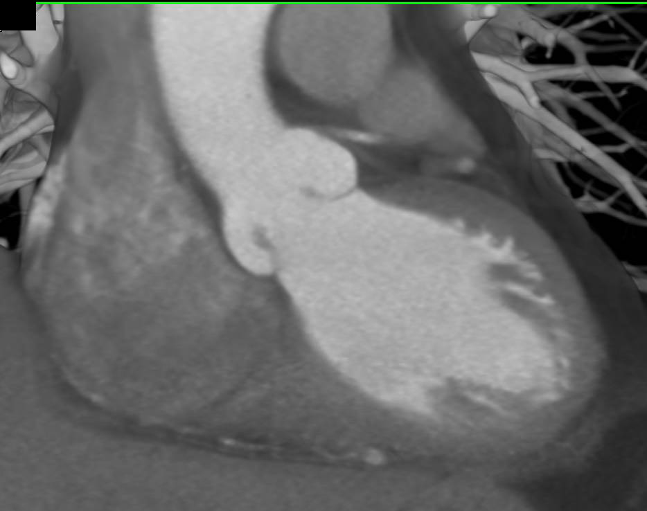 Aortic Valve with Leaf Calcification - CTisus CT Scan