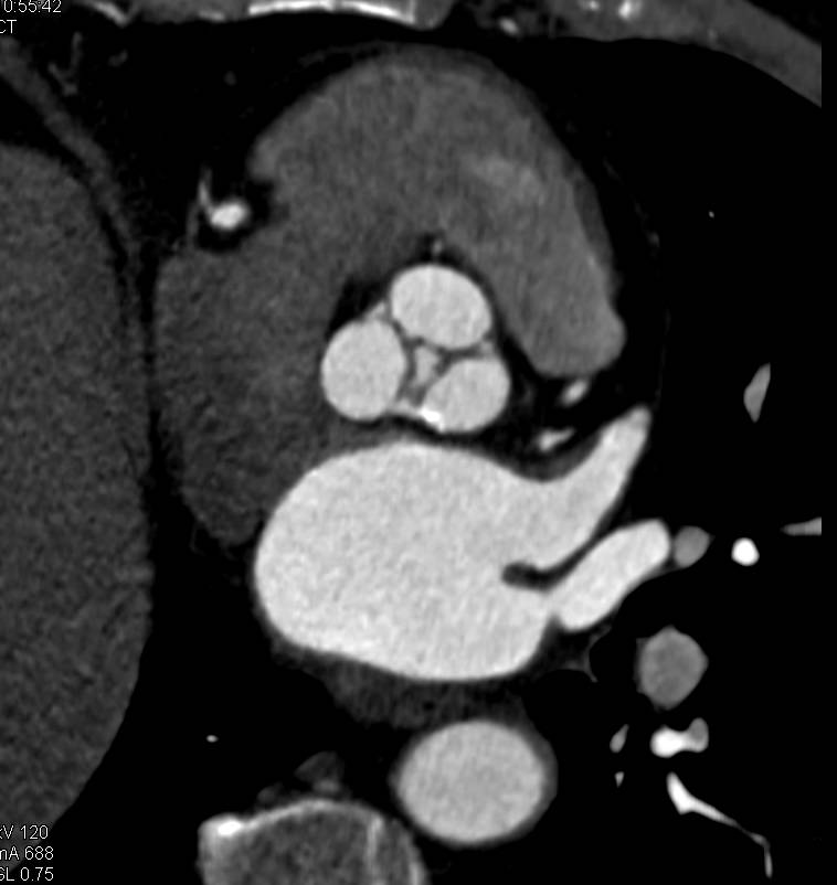 Thickened Aortic Valve Leaflets - CTisus CT Scan