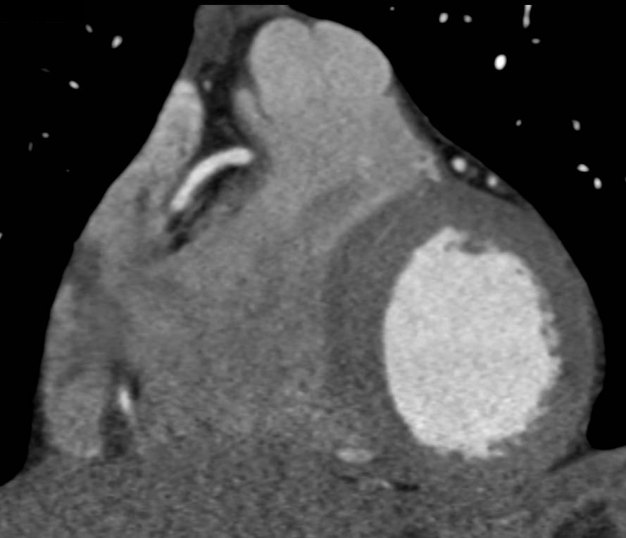 CCTA: Critical Right Coronary Artery (RCA) Stenosis in Multiple Perspectives - CTisus CT Scan