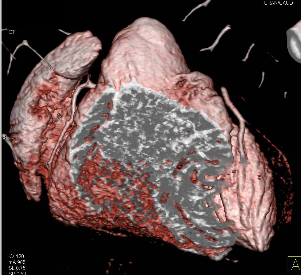 CTA: 3D Mapping of the Coronary Arteries - CTisus CT Scan