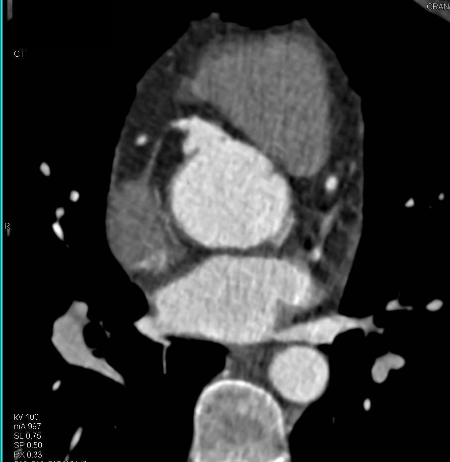 Aortic Root Repair with Reimplantation of the Coronary Arteries - CTisus CT Scan