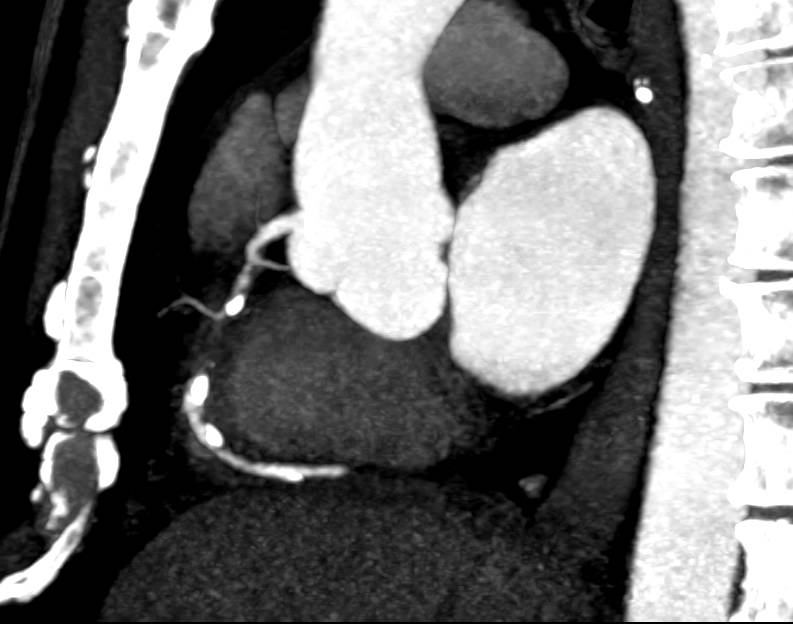 CCTA: Occlusion of the Right Coronary Artery - CTisus CT Scan