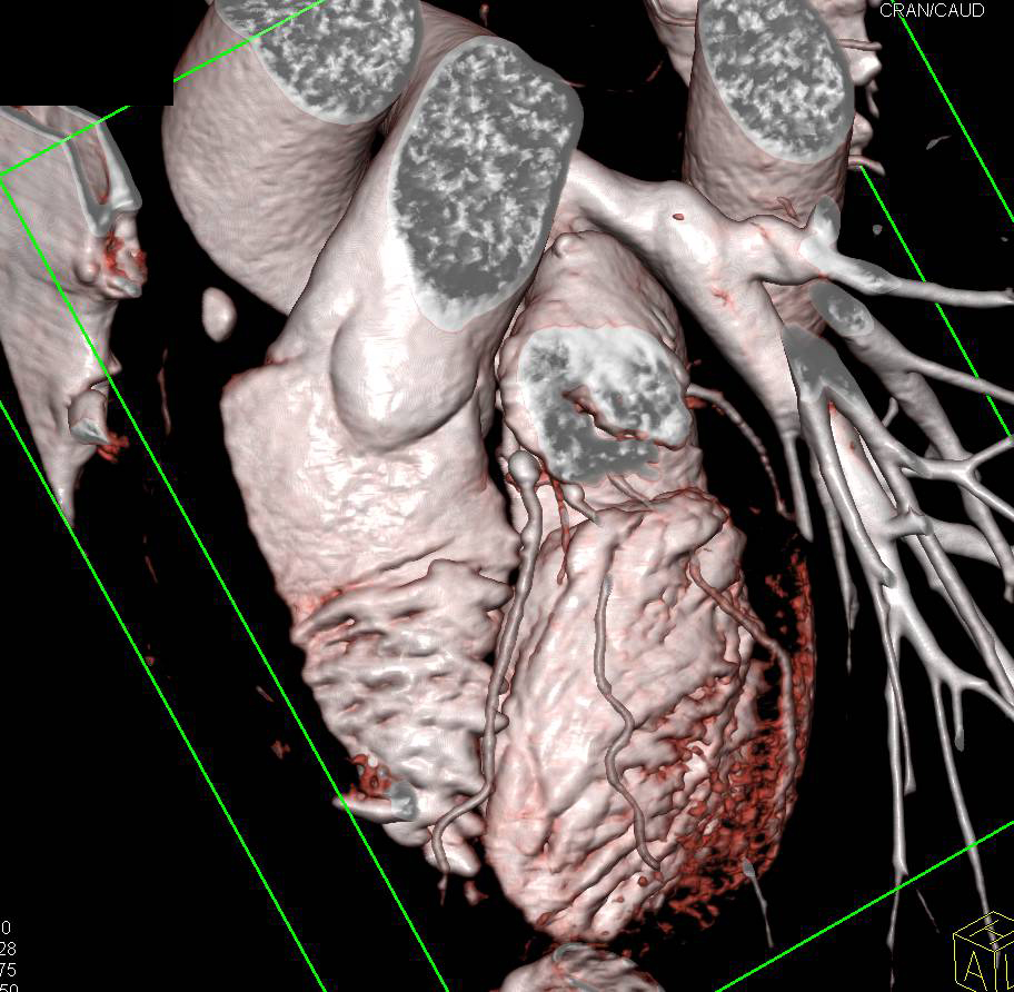 CCTA: Coronary Artery Disease with Calcified Plaques on All Vessels - CTisus CT Scan