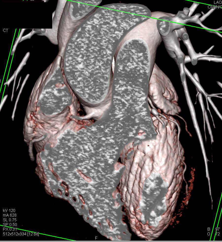 CCTA: Coronary Artery Disease with Calcified Plaques on All Vessels ...