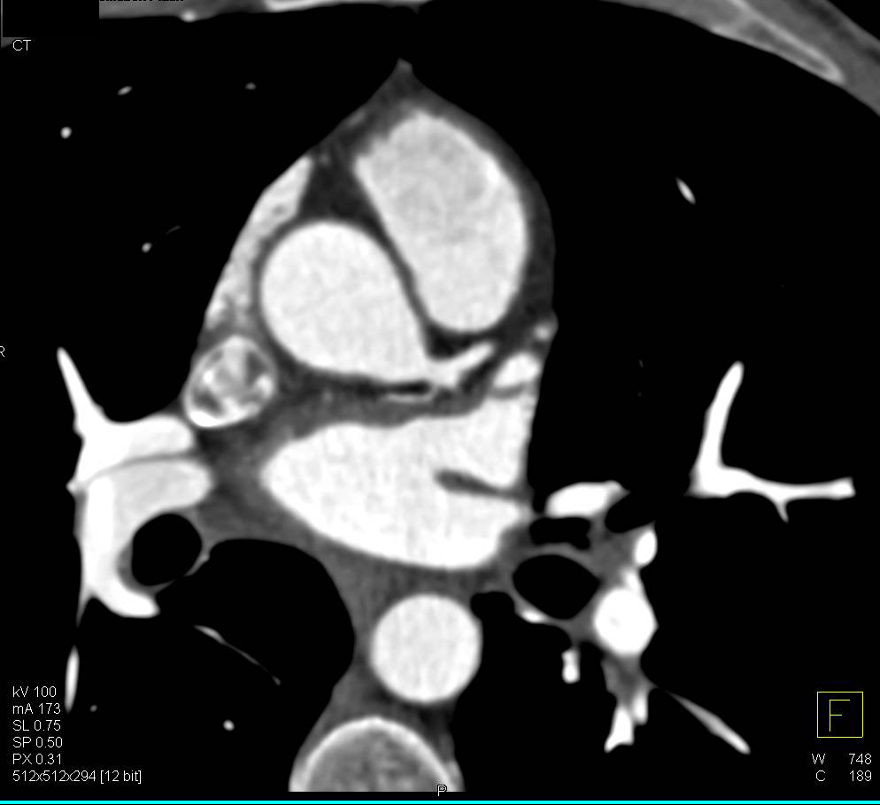 CCTA: SA Nodal branch Arises from the Circumflex Coronary Artery - CTisus CT Scan