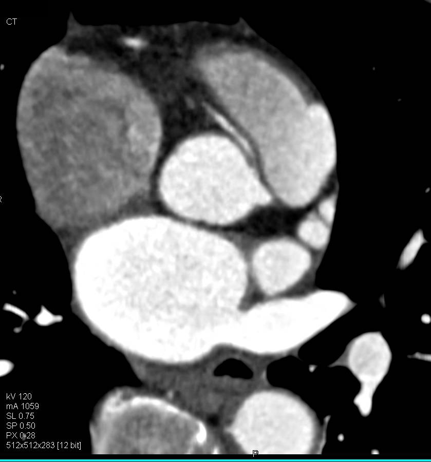 CCTA: Right Coronary Artery (RCA) Arises off Left Cusp in Malignant Configuration - CTisus CT Scan