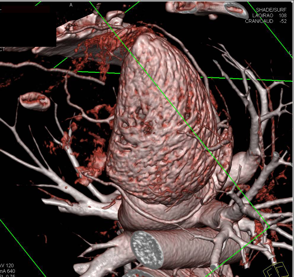 CCTA: Normal Coronary Artery Study with Various Displays - CTisus CT Scan